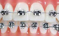 Traditional Braces in Scarborough, ON